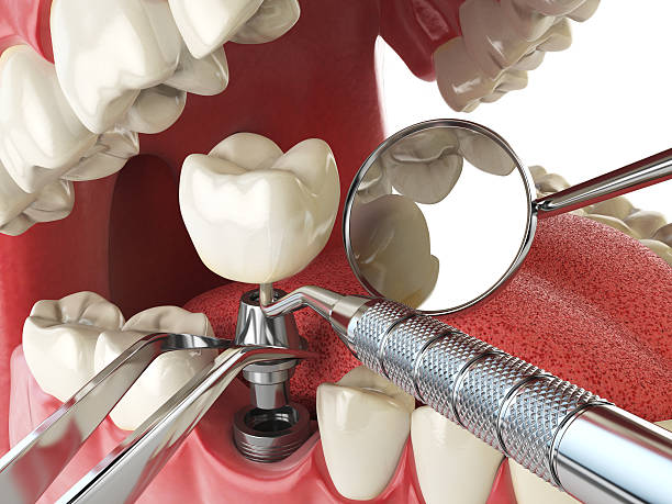 Best Emergency Dental Services for Seniors in Severn, MD